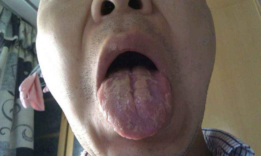 舌头病症的图片大全