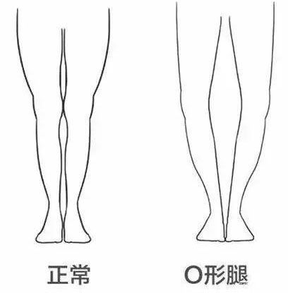 正常人站直的腿型图片