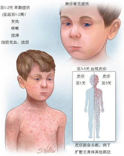 麻疹早期症状图片