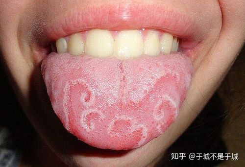 舌头病症的图片大全