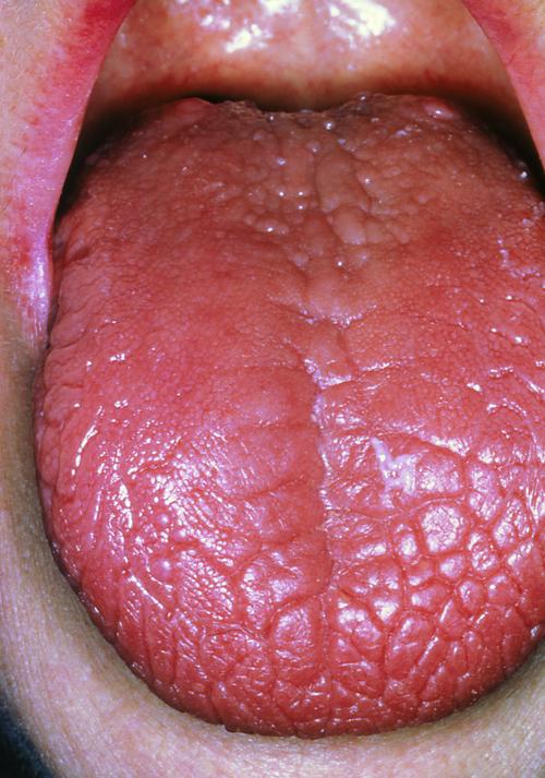 正常人的舌底肉芽图片